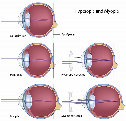 miopia hipermetropia astigmatismo cercetarea viziunii profunde